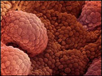 câncer de próstata