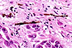 Microscopic thin section showing lung tissue with asbestosis, mesothelioma