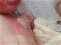 دسوځيدلي ماشوم سره مرسته