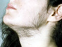 Jovem com hirsutismo