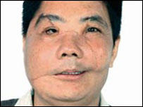 Paciente chinês submetido a transplante de rosto. Foto: Lancet