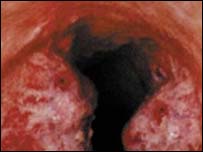 تمباکونشی سے متاثر پھیپھڑے