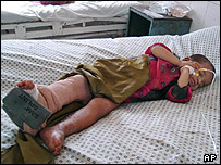 یک کودک افغان که گفته می شود در حمله هوایی ناتو زخمی شده است