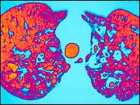 Raio X mostra pulmões afetados pela fibrose cística