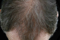 Brian Beacom six months after his hair transplant
