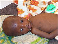 Pessoas afectadas pela fome e desnutrição estão sim mais susceptíveis a infecções e doenças 