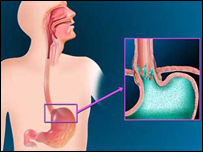 دمعدې تېزاب