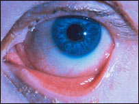 د سترګو ناروغۍ