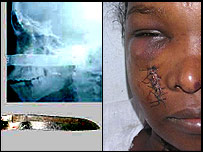 Raio-x mostrando a navalha (esq.); a vítima em recuperação(dir.)