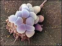 سلول سرطانی تخمدان