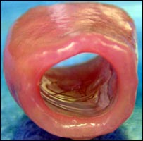 Enxerto de traquéia feito de células-tronco