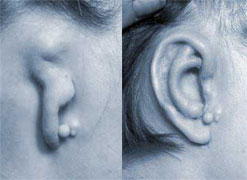 An ear before and after reconstructive treatment for microtia (courtesy of Mr David Gault's website)