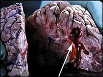 تمباکونوشی سے متاثرہ دماغ