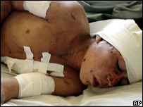 افغان زخمی(فائل فوٹو)