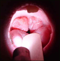 تانسل های گلو