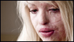 Katie Piper - burnt in an acid attack