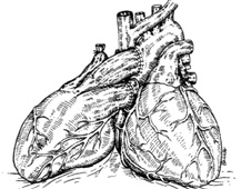 Illustration of the "piggy-back" donor heart