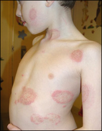 بيماری قارچ (فنگس)