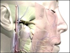 Recreación de un transplante de cara