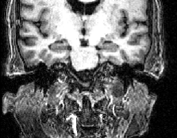 Alan Duncan's brain scan