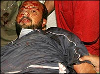 Zraněný Palestinec