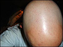 बाल गिरने के कई कारण हो सकते हैं