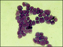 Células de leucemia