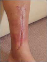 Paul Fry's leg, showing a scar.