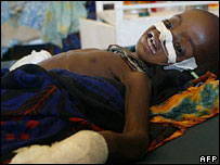 Criança desnutrida internada em hospital da Somália