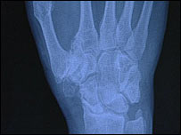 手部的X光照片