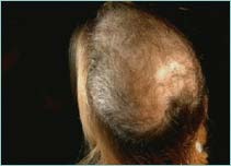 Extent of hair loss