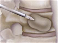 دهډوکو ورستېدل