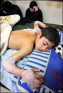 Chlapec zraný při výbuchu bomby v pátek večer