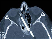दिमाग में धंसी पेंसिल