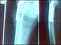 کاهش استحکام بافت استخوان می تواند سبب ابتلا به پوکی استخوان شود