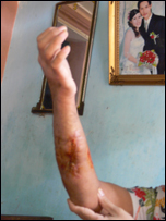 Một ngư dân bị tàu Trung Quốc bắn bị thương