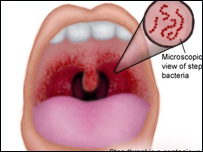 وقايه گلو دردی