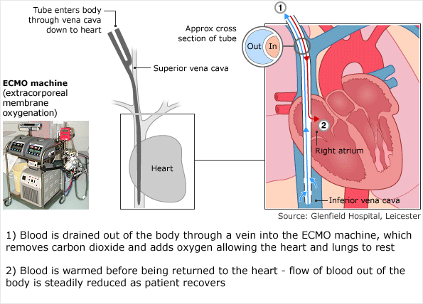 How EMCO works: 1) Blood is drained out of the body through a vein into the ECMO machine, which removes carbon dioxide and adds oxygen allowing the heart and lungs to rest 2) Blood is warmed before being returned to the heart - flow of blood out of the body is steadily reduced as patient recovers 