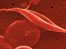 Sickle Cell