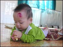 Trẻ em nhiễm HIV ở Việt Nam