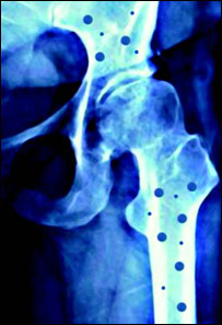 پوکی استخوان