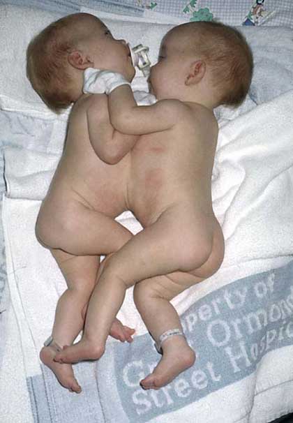 Siamese-twins-7_blog-full.jpg