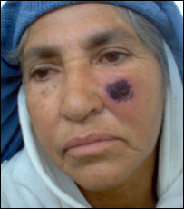 يوه ښځه چې په مخ يې کالدانه راختلې ده.