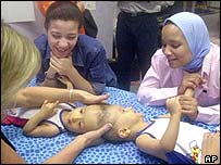 Gêmeos siameses separadas pela cabeça