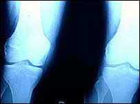 آرتریت رماتوئید