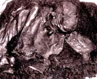 Photograph of the bog body found at Lindow Moss in Cheshire