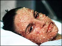 Último caso de varíola foi registrado em 1977